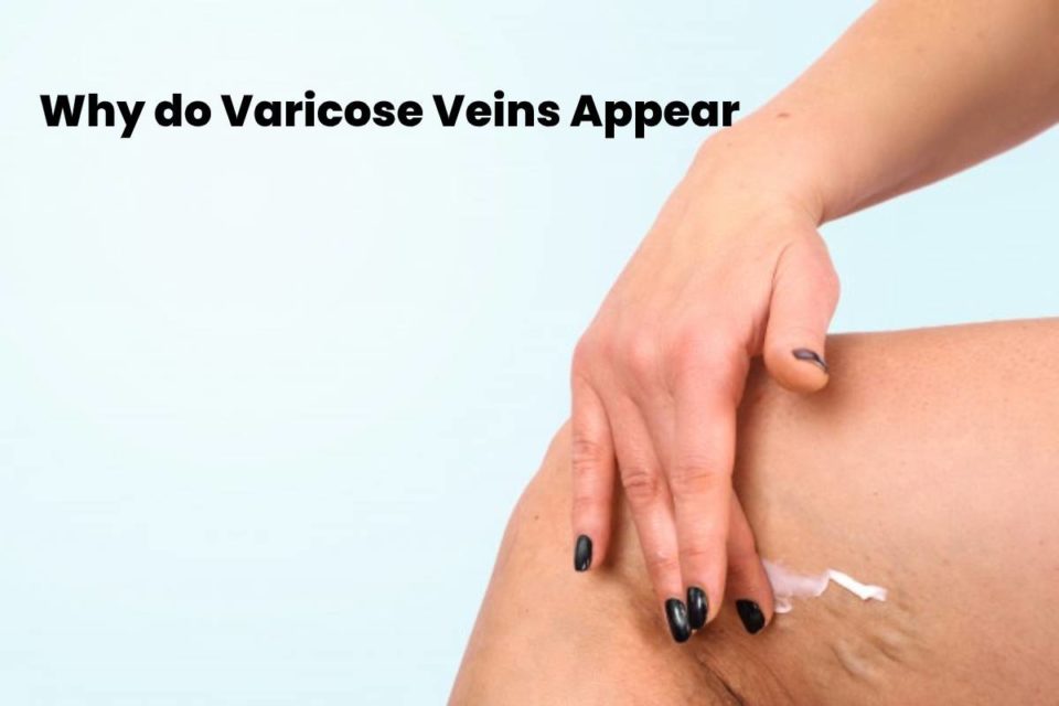 Varicose Veins