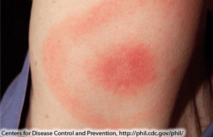 Lyme Disease 