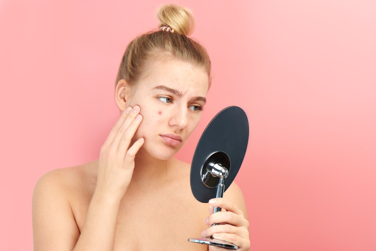 Top 4 Tips For Dealing With Acne [2021] BeingNaturalHuman