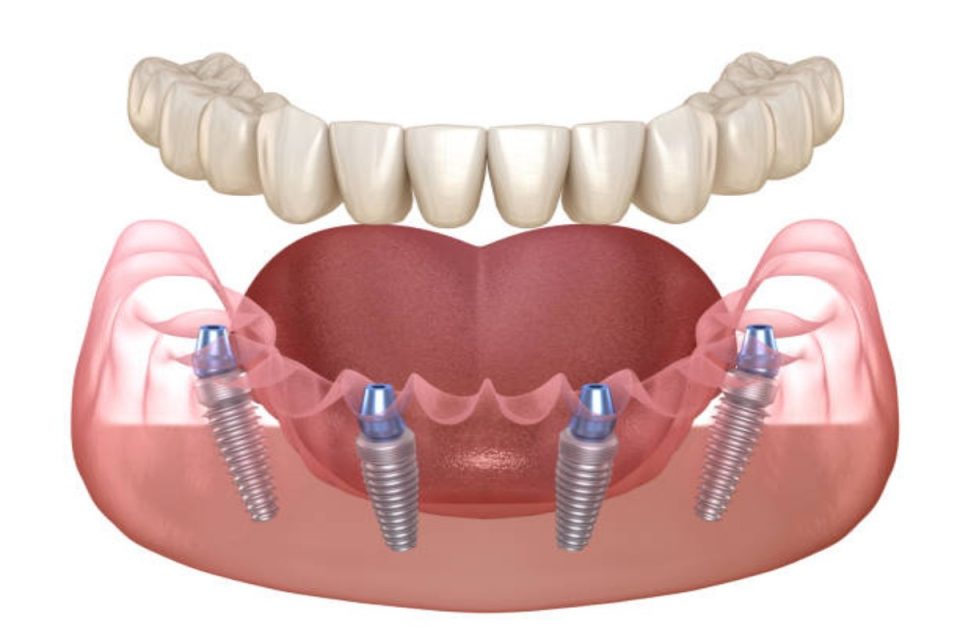 Dental Implants