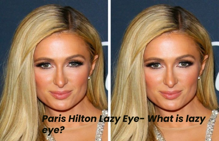 Overview Paris Hilton Lazy Eye (1)