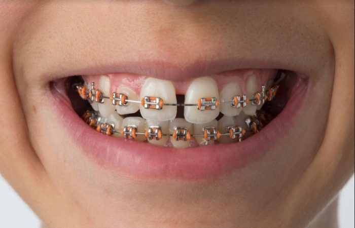 Braces 