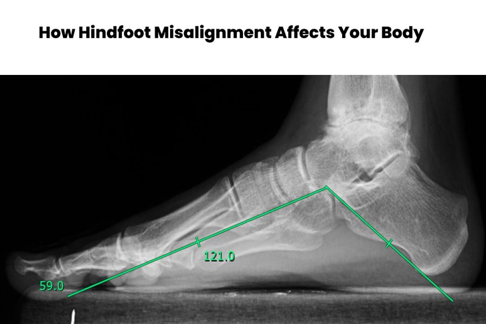 Hindfoot Misalignment