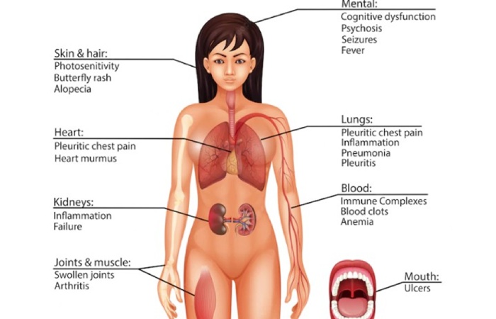 Lupus Erythematosus