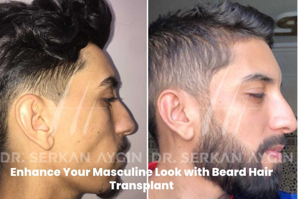 Beard Hair Transplant