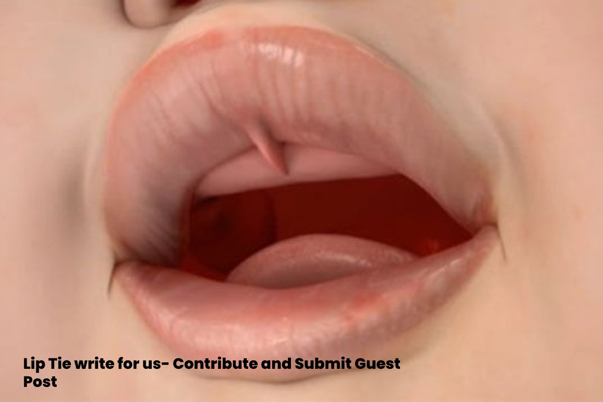 Lip Tie Write for us- Overview