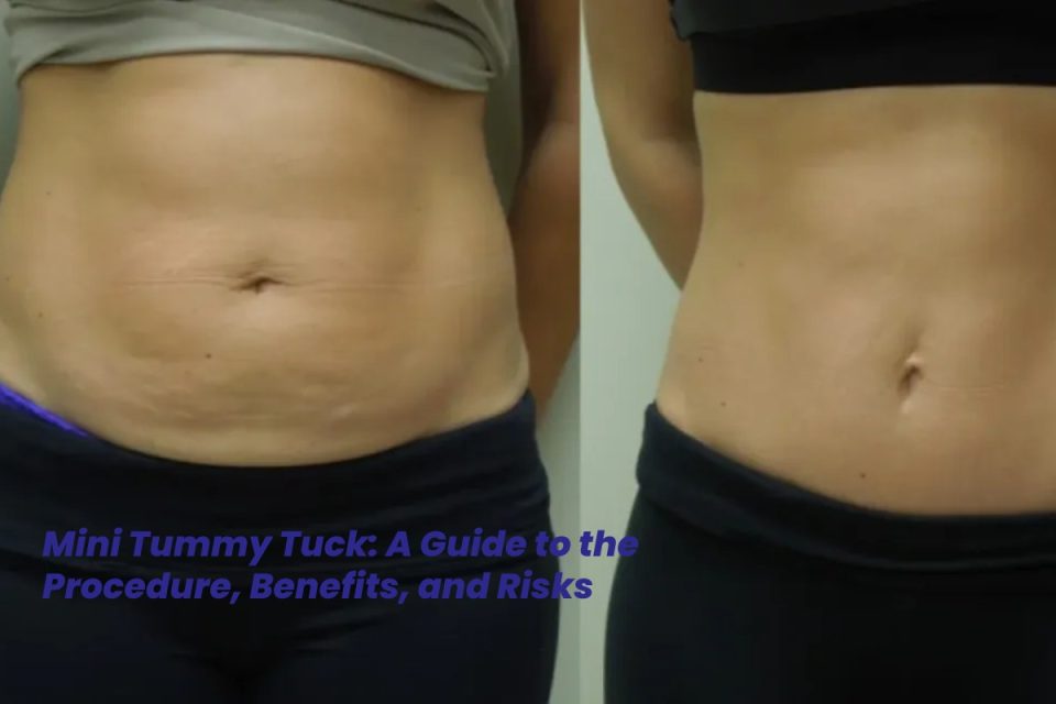 Mini Tummy Tuck