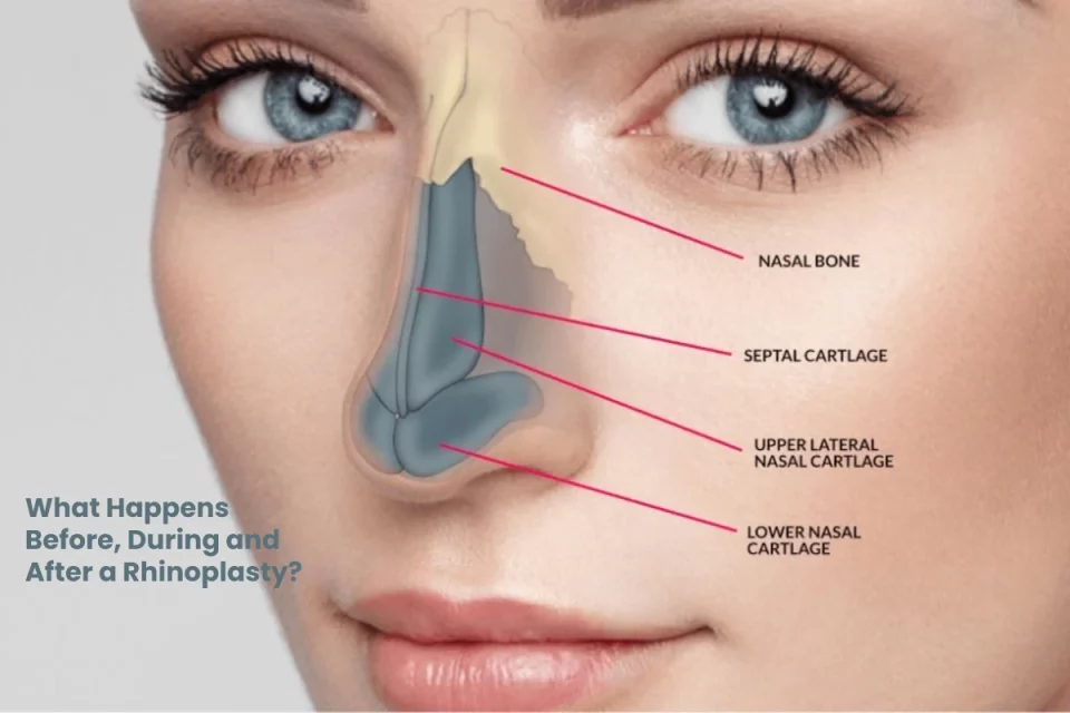 Rhinoplasty