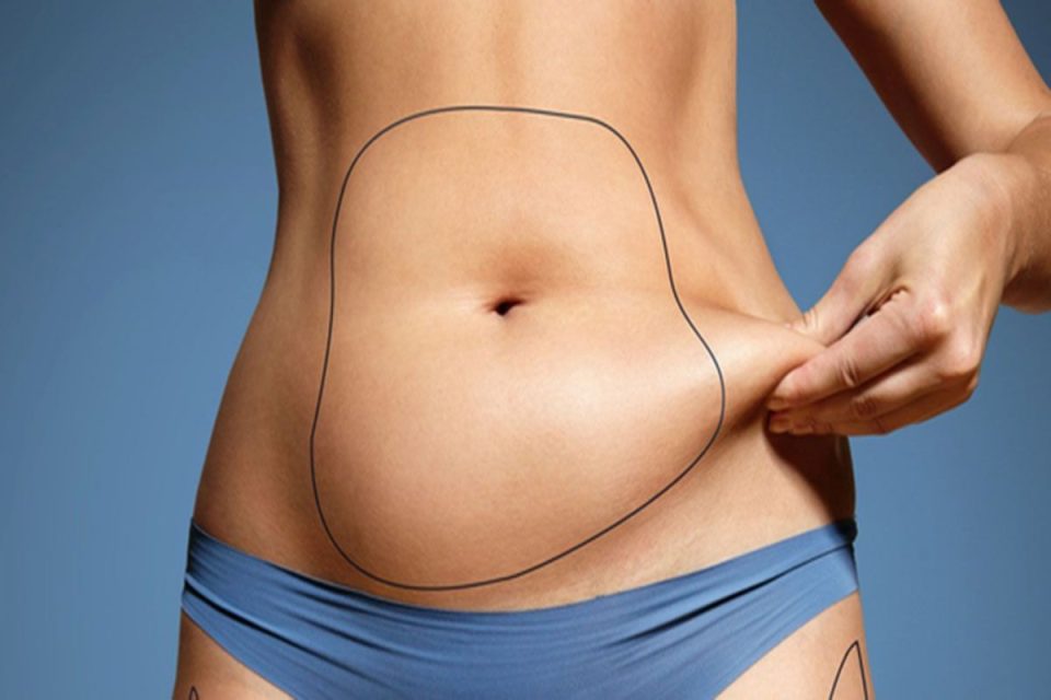 Coolsculpting