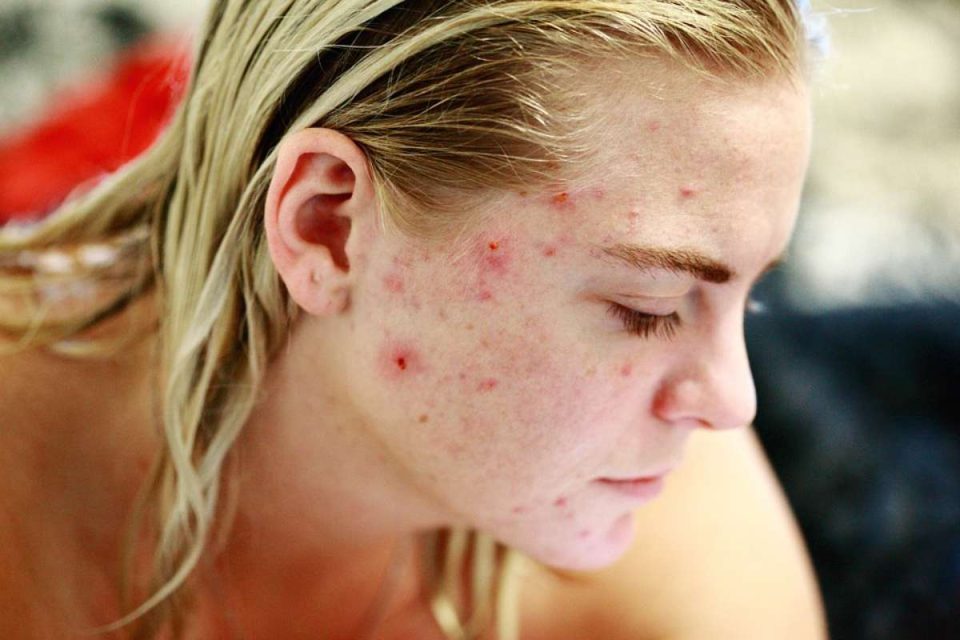 5 Home Remedies for Acne