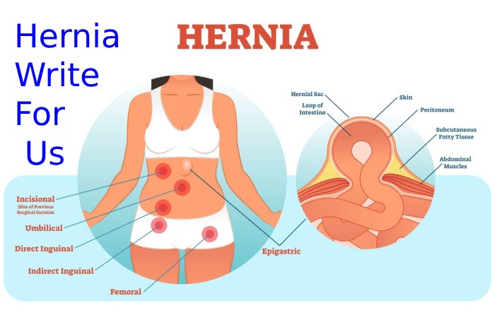 Hernia Write For Us