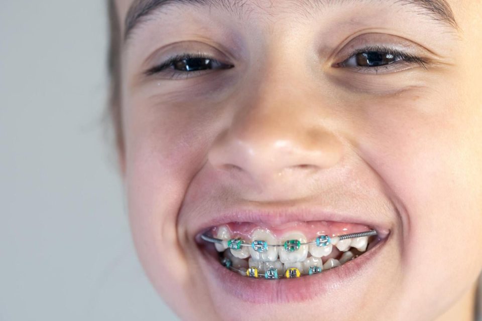 5 Tips For Choosing Braces For Kids