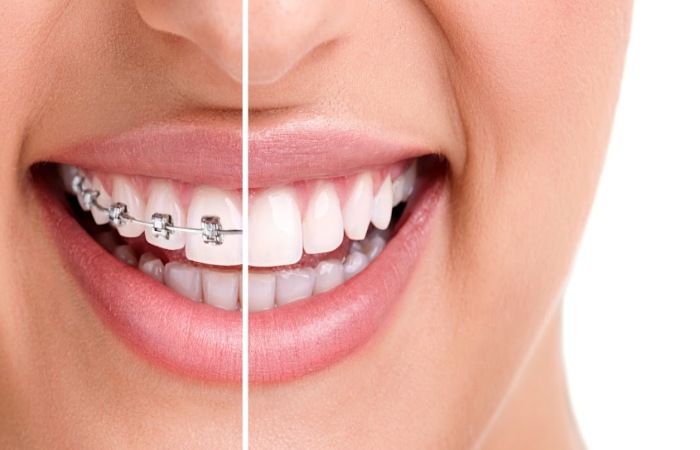 Choose The Right Orthodontist