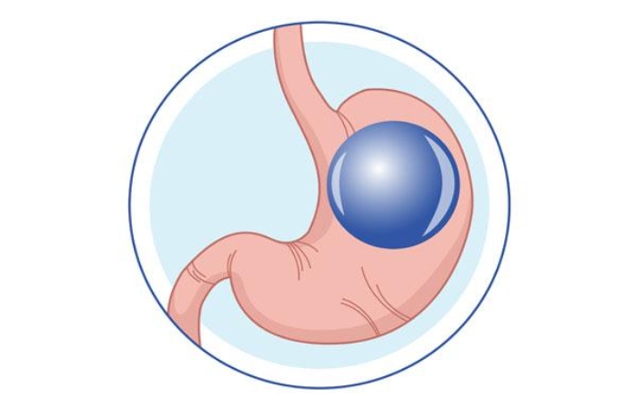 Benefits Of Gastric Balloon Surgery