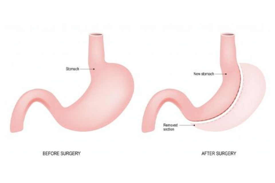 Gastric Balloon Surgery