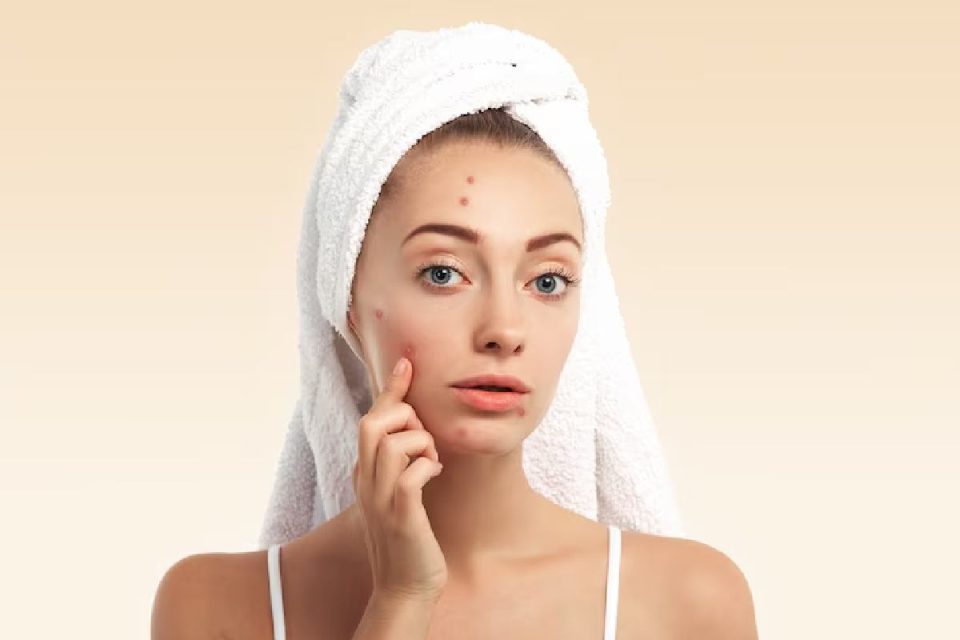 Acne Spot Removal Creams