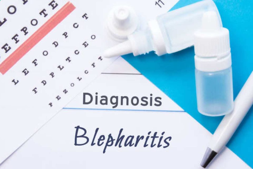 Demodex Blepharitis