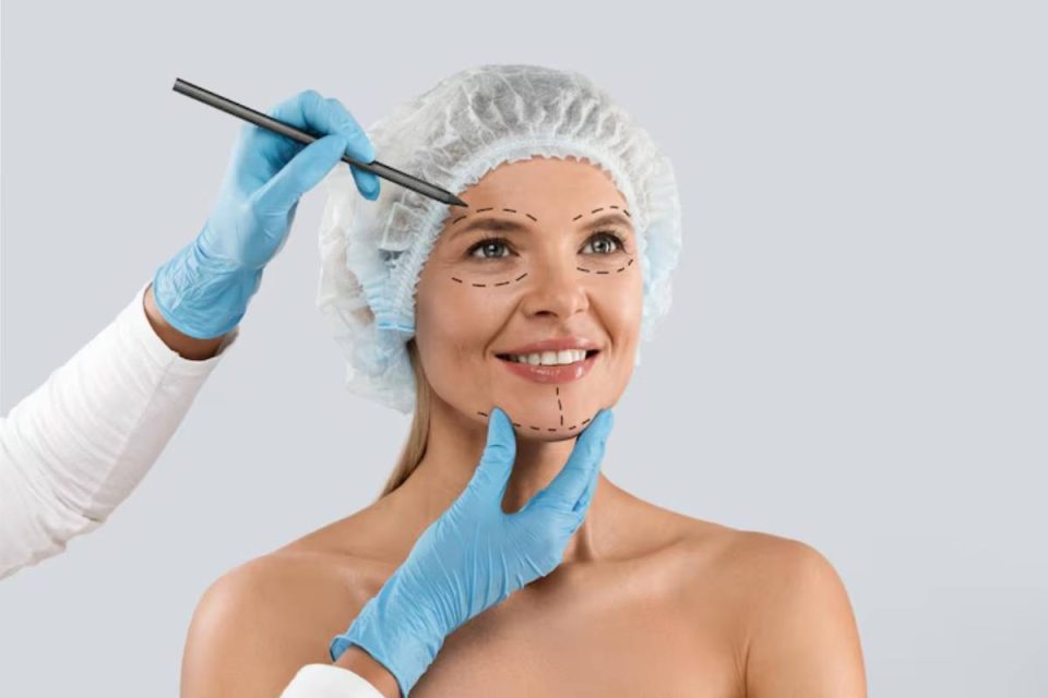 Facelift