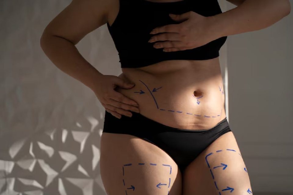 Mini Tummy Tuck